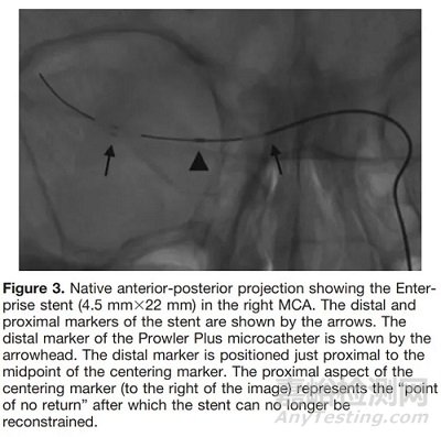 支架取栓器的設計與制造