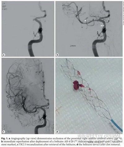 支架取栓器的設計與制造