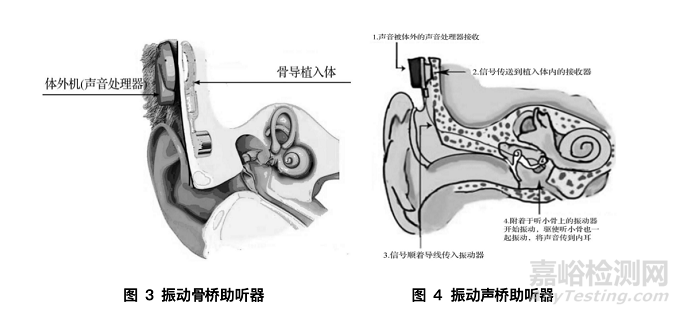骨導(dǎo)助聽器的醫(yī)械分類、標準與注冊要點