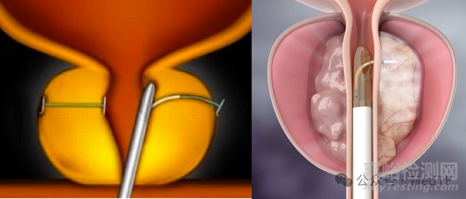 五年110萬臺真實(shí)臨床研究,揭露BPH治療方式巨變