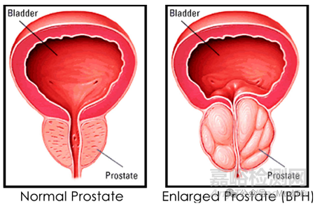 BPH創(chuàng)新療法之創(chuàng)新支架技術(shù)匯總