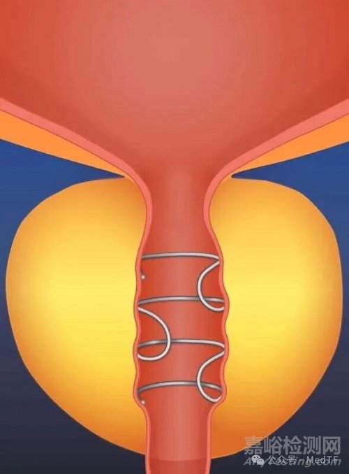 BPH創(chuàng)新療法之創(chuàng)新支架技術(shù)匯總