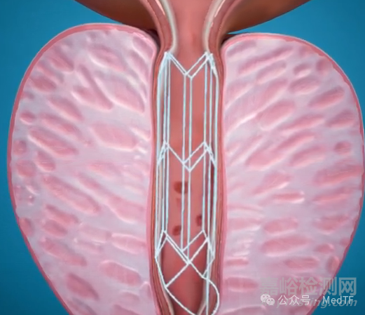 BPH創(chuàng)新療法之創(chuàng)新支架技術(shù)匯總