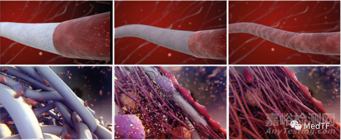 【創(chuàng)新醫(yī)械】aXess：可再生人工血管安全性和有效性均優(yōu)于傳統(tǒng)AVF和AVG
