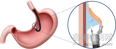 【創(chuàng)新醫(yī)械】ROBOPERA:消化內(nèi)鏡手術(shù)機(jī)器人獲FDA批準(zhǔn)上市
