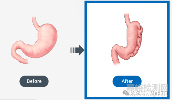 【創(chuàng)新醫(yī)械】ROBOPERA:消化內(nèi)鏡手術(shù)機(jī)器人獲FDA批準(zhǔn)上市