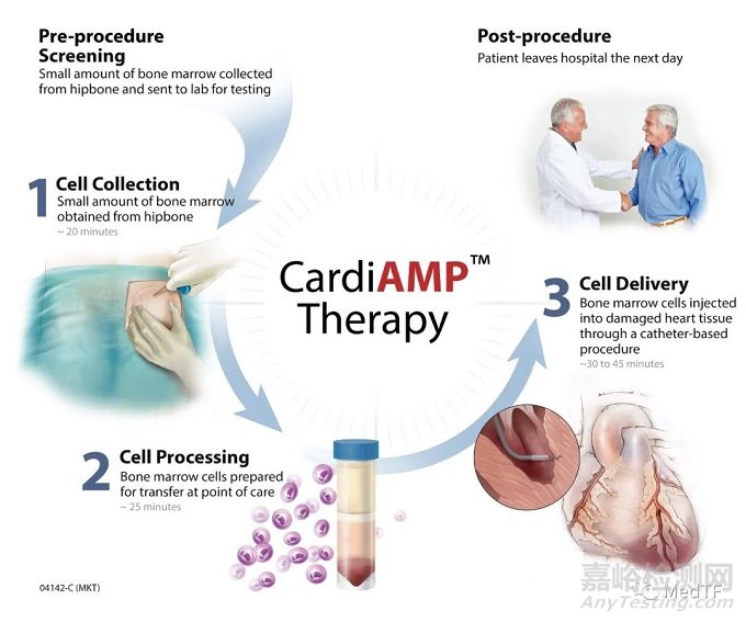 CardiAMP：自體細(xì)胞使心絞痛發(fā)作頻率降低82% | 明顯優(yōu)于藥物
