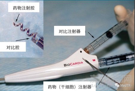 CardiAMP：自體細(xì)胞使心絞痛發(fā)作頻率降低82% | 明顯優(yōu)于藥物