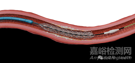 【創(chuàng)新醫(yī)械】Spur Elute:可回收藥物洗脫冠脈支架
