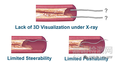 【創(chuàng)新醫(yī)械】Santreva-ATK：血管內(nèi)血運重建導管獲FDA批準上市，無導絲CTO病變通過率高達90%