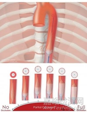 【創(chuàng)新醫(yī)械】pREBOA PRO：美軍相中的主動脈球囊阻斷止血神器獲批FDA