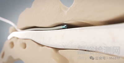 【創(chuàng)新醫(yī)械】Epiduro：革命性的軟體脊柱手術(shù)機(jī)器人