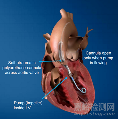 強生自動Impella控制器（AIC）3個月4次一級召回