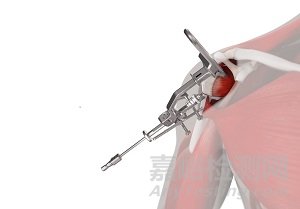 強(qiáng)生推出肩關(guān)節(jié)置換系統(tǒng)