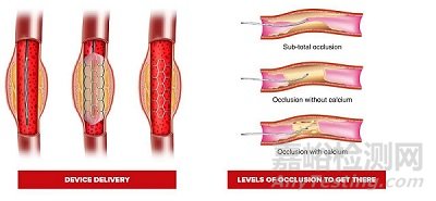 樂普心泰硬導(dǎo)絲獲批上市