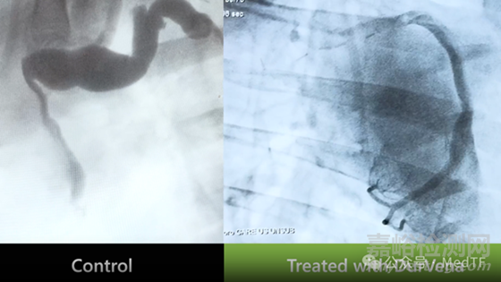 【創(chuàng)新醫(yī)械】PTP：光固化大隱靜脈減輕冠脈搭橋“橋血管”擴(kuò)張 ，大幅降低“橋血管”失敗率