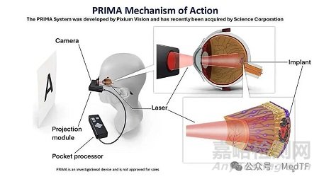 【創(chuàng)新醫(yī)械】Prima：視覺假體腦機(jī)接口讓80%失明患者恢復(fù)視力