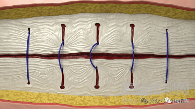 【創(chuàng)新醫(yī)械】DURAMESH:全球唯一的網(wǎng)狀縫線獲批上市