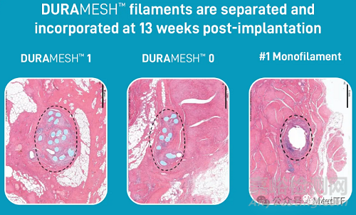 【創(chuàng)新醫(yī)械】DURAMESH:全球唯一的網(wǎng)狀縫線獲批上市