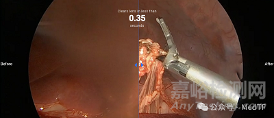 【創(chuàng)新醫(yī)械】troCarWash：自帶清洗鏡頭功能的5mm穿刺器 ，時刻保持內(nèi)窺鏡鏡頭清晰