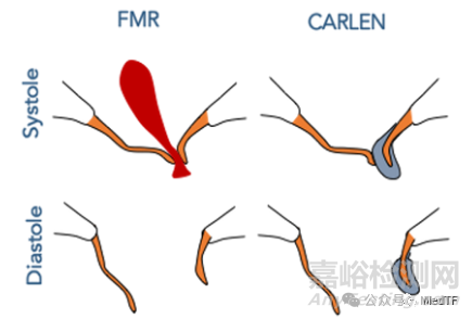 CARLEN：瓣葉增強器治療二尖瓣反流啟動FIM研究