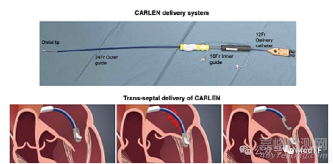 CARLEN：瓣葉增強器治療二尖瓣反流啟動FIM研究
