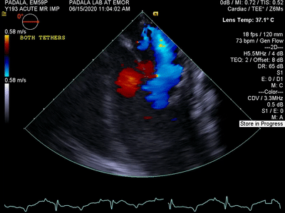 CARLEN：瓣葉增強器治療二尖瓣反流啟動FIM研究