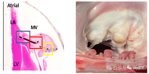 CARLEN：瓣葉增強器治療二尖瓣反流啟動FIM研究