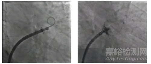 全球首款，波科涂層左心耳封堵器獲批上市