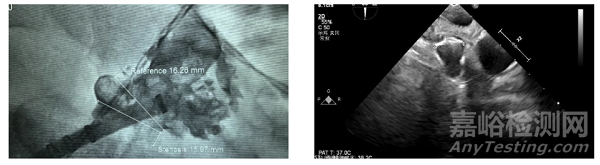 全球首款，波科涂層左心耳封堵器獲批上市