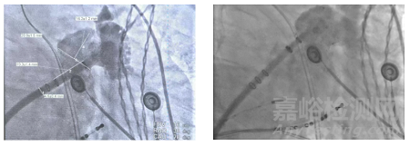 全球首款，波科涂層左心耳封堵器獲批上市