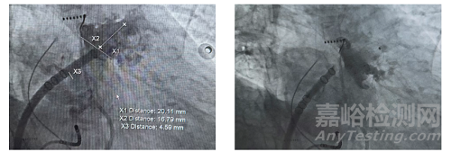 全球首款，波科涂層左心耳封堵器獲批上市