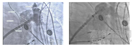 全球首款，波科涂層左心耳封堵器獲批上市