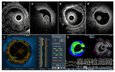 泰爾茂首款雙模一體化腔內(nèi)成像導(dǎo)管獲FDA批準(zhǔn)上市