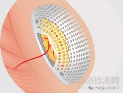 【創(chuàng)新醫(yī)械】MATTISSE：可再生乳房假體