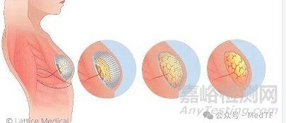 【創(chuàng)新醫(yī)械】MATTISSE：可再生乳房假體