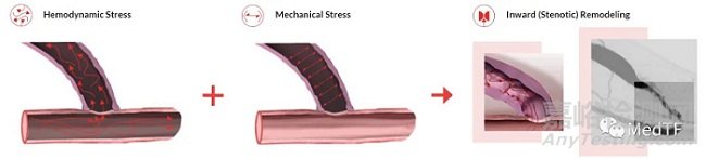 【創(chuàng)新醫(yī)械】螺旋狀人工血管獲FDA批準上市