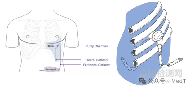 全球首款且唯一完全植入式自動(dòng)積液分流裝置臨床數(shù)據(jù)公開