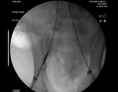 【創(chuàng)新醫(yī)械】Recana：用于靜脈支架再狹窄的取栓導(dǎo)管獲批FDA，遠(yuǎn)端帶有栓塞收集器