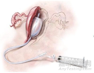 剛剛，一次性使用球囊子宮支架審評(píng)要點(diǎn)征求意見（附全文）