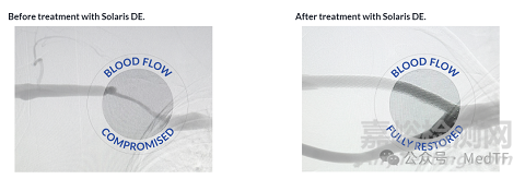 【創(chuàng)新醫(yī)械】Solaris DE：藥物洗脫覆膜支架，6個月初級通暢率高達95%