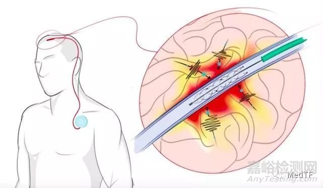 【創(chuàng)新醫(yī)械】Stentrode：全球首款血管內(nèi)腦機(jī)接口產(chǎn)品