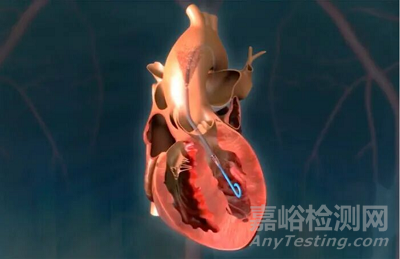 TCT2025:全球心脈技術(shù)亮點全梳理