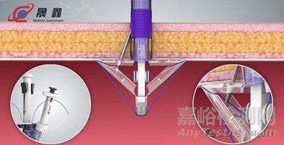 【創(chuàng)新醫(yī)械】國產(chǎn)穿刺、縫合二合一的新型腹壁穿刺縫合器