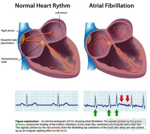 微創(chuàng)電生理創(chuàng)新醫(yī)械“一次性使用壓力檢測(cè)心臟脈沖電場(chǎng)消融導(dǎo)管”技術(shù)解析