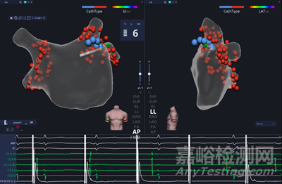 微創(chuàng)電生理創(chuàng)新醫(yī)械“一次性使用壓力檢測(cè)心臟脈沖電場(chǎng)消融導(dǎo)管”技術(shù)解析