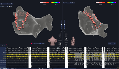 微創(chuàng)電生理創(chuàng)新醫(yī)械“一次性使用壓力檢測(cè)心臟脈沖電場(chǎng)消融導(dǎo)管”技術(shù)解析