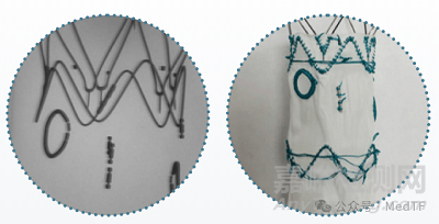 【創(chuàng)新醫(yī)械】泰爾茂自由開窗的腹主動脈支架