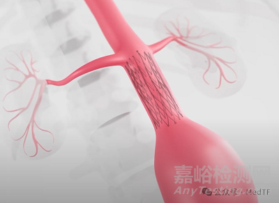 【創(chuàng)新醫(yī)械】A3-Shield：抑制腹主動脈瘤增長的支架，從根本上解決AAA