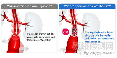 【創(chuàng)新醫(yī)械】A3-Shield：抑制腹主動脈瘤增長的支架，從根本上解決AAA
